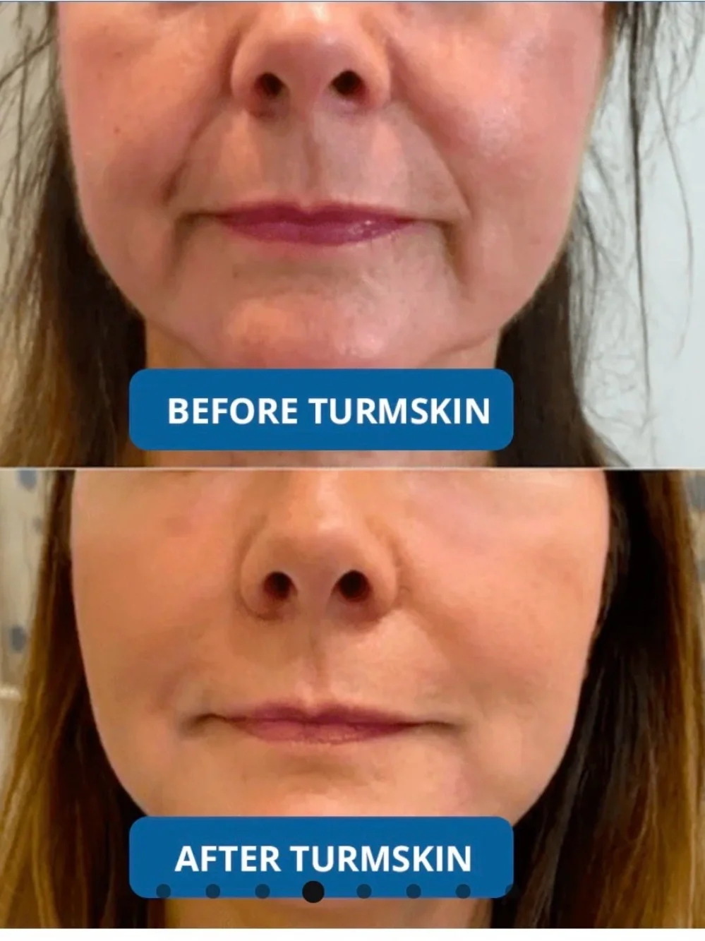 TurnSkin 3% Hyaluronic Acid Serum Vials - Hydrating Face Serum - 2 New Boxes